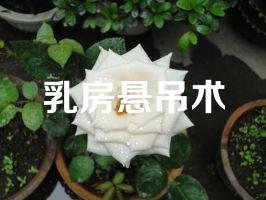 乳房悬吊术